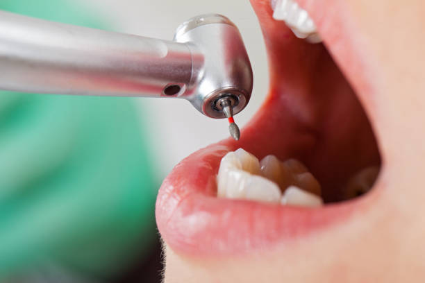 Best Emergency Treatment for Dental Infections or Abscesses in Delhi Hills, OH